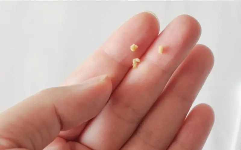 7-Year-Old Boy Bullied Over Bad Breath, Mother Shocked by What Doctors Found in His Mouth
