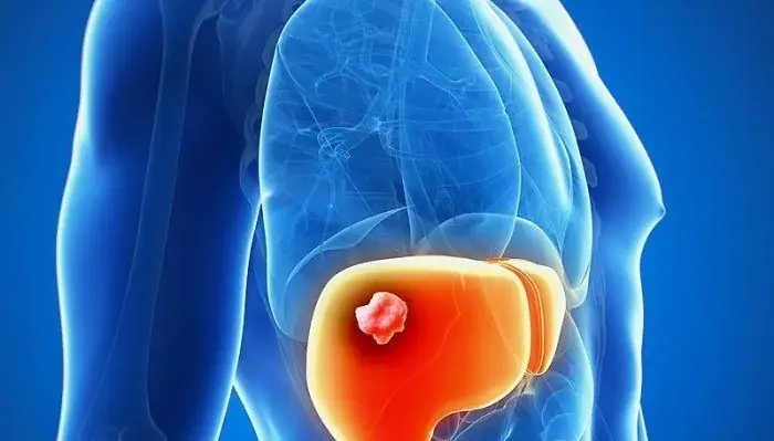 8 Common Early Symptoms That May Be Associated With Stomach Can.cer