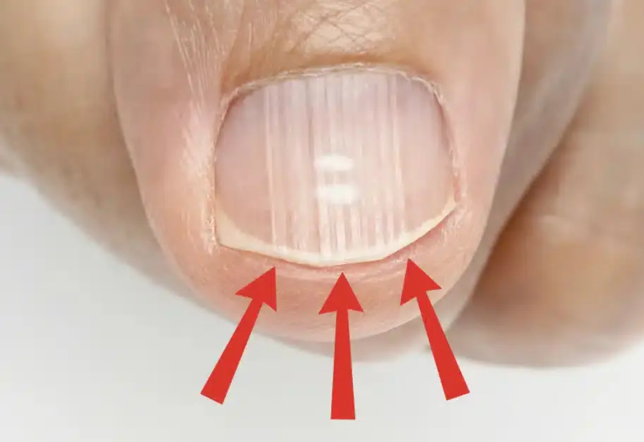 Nail Lines After 40? Here’s What Your Body May Be Trying to Tell You