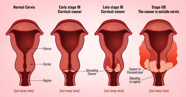 Could These Be Early Signs of Cervical Cancer? 5 Symptoms to Know