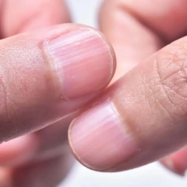 Doctor Explains What Lines on Your Fingernails May Reveal About Your Health