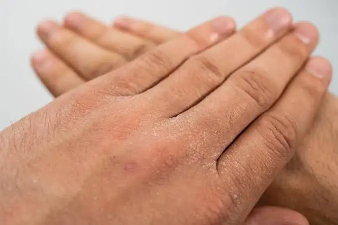 Is Your Body Trying to Tell You Something? 8 Possible Signs of Nutrient Deficiencies