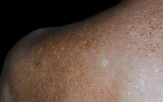 Those Little White Spots on Your Arms Could Be More Than Just a Skin Change