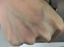 Visible Veins on Your Hands? Don’t Ignore Them Until You Know What They Could Mean