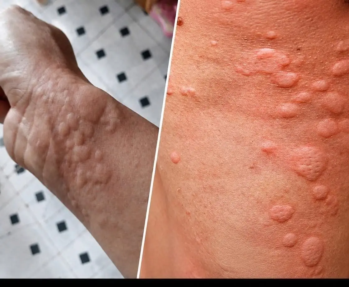Thought It Was Just an Allergy, but Doctors Discovered an Unexpected Truth