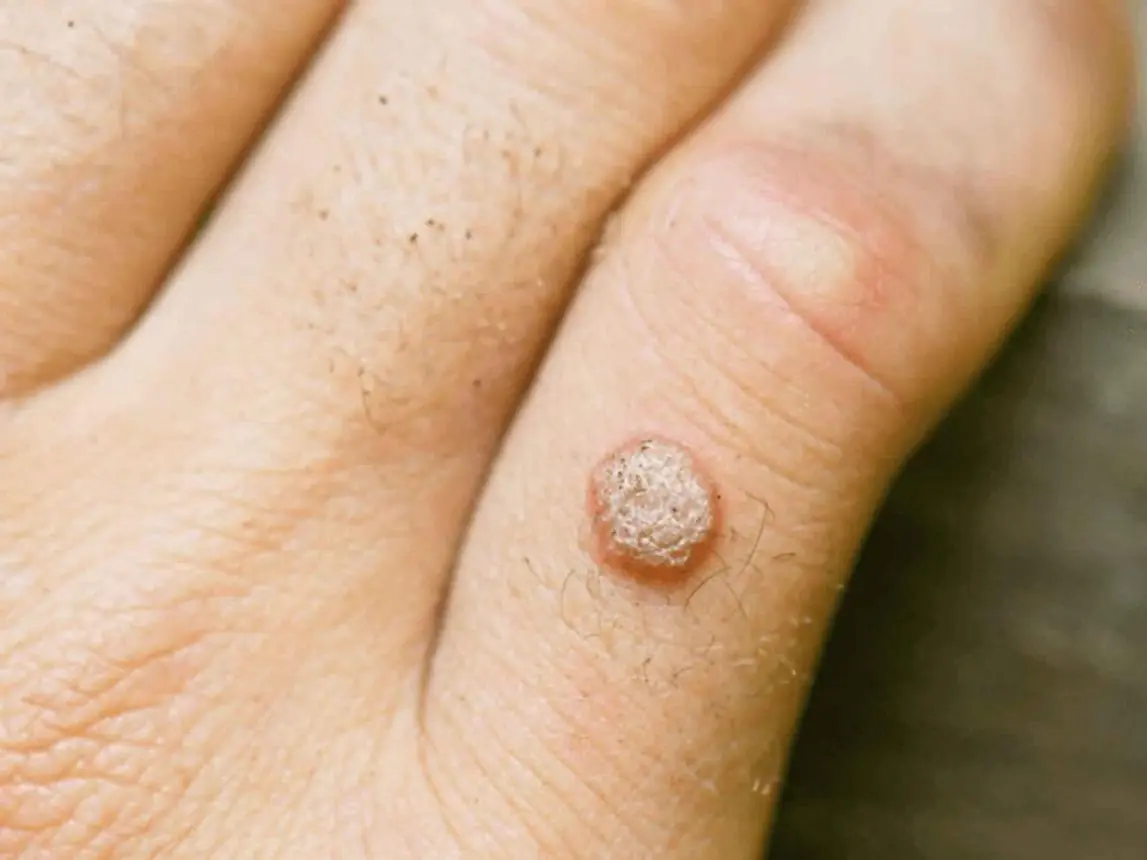 Warts or Skin Tags? Here's the Safest Way to Get Rid of Them