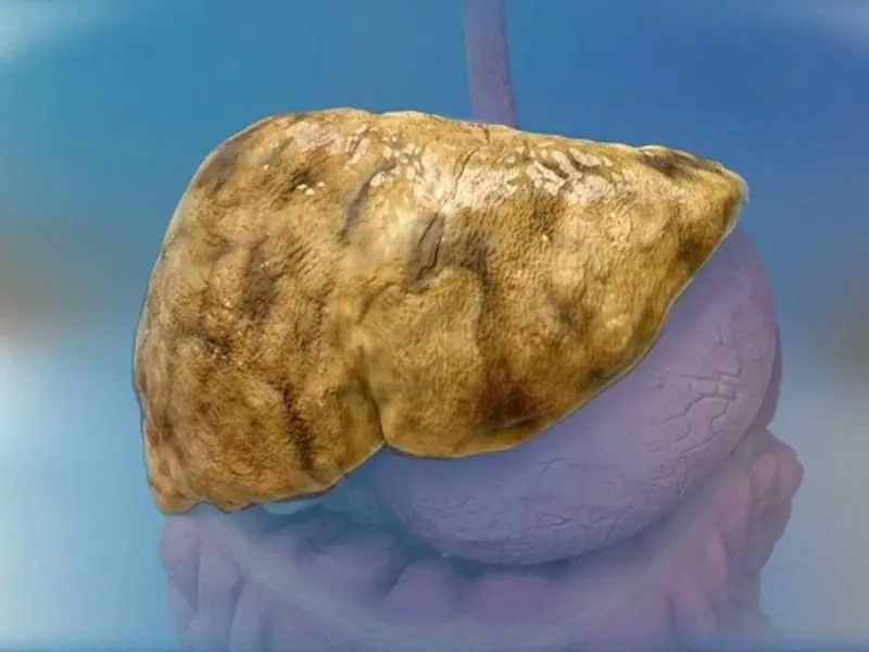 Fatty Liver Disease: Early Signs, Treatment Options and Prevention Strategies