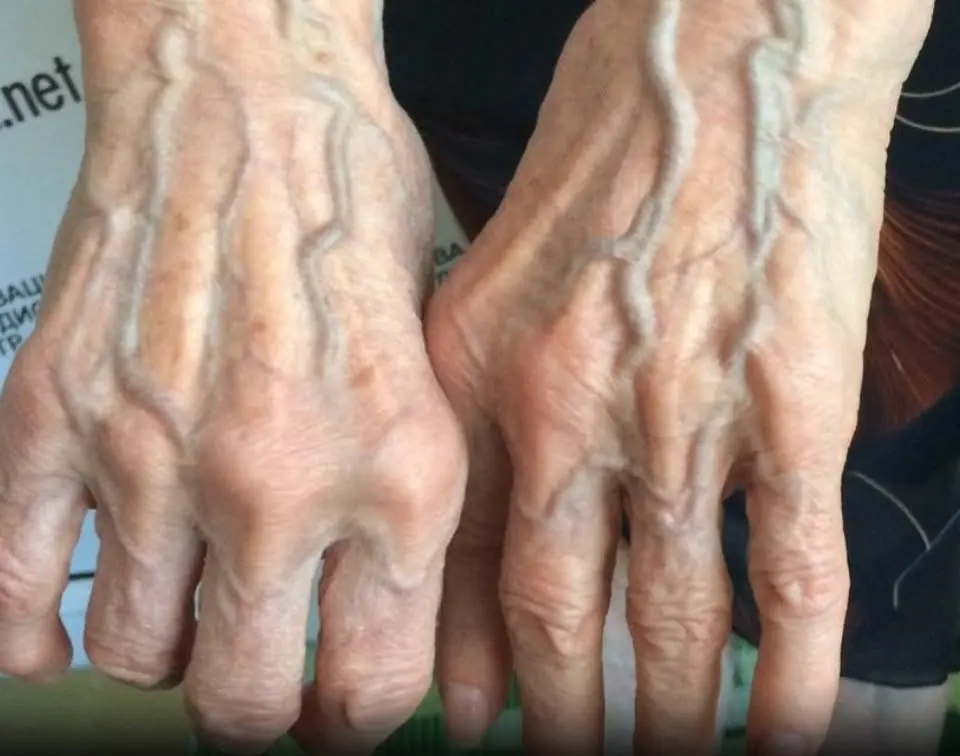 Bulging Veins …When They’re Harmless and When They Could Signal a Problem