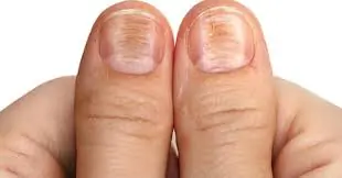 Your Nails Could Reveal Clues About Your Overall Health — Do You Notice These Signs?