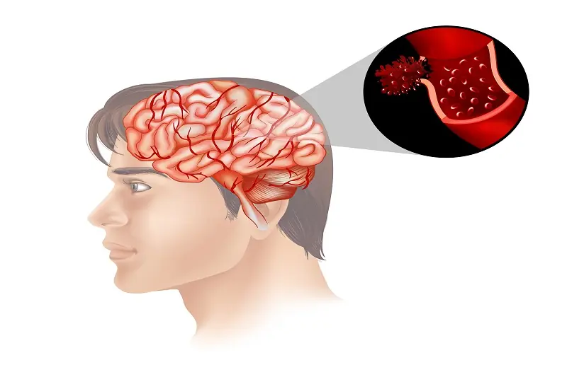 Brain Aneurysms: 15 Possible Warning Signs and When to Seek Emergency Care