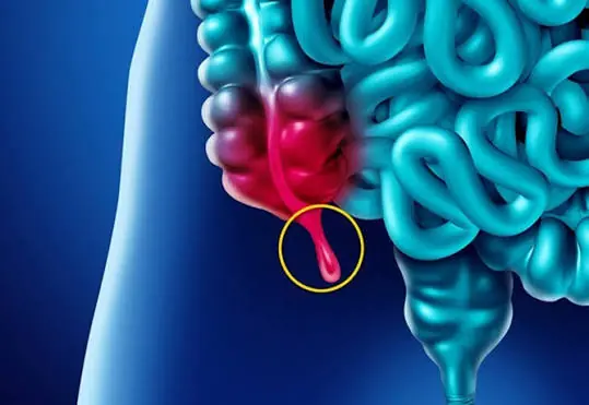 Don't Ignore These 6 Possible Warning Signs of Appendicitis