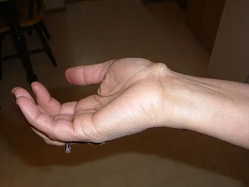 A Wrist Bump Doesn't Always Mean Something Serious - It Could Be a Ganglion Cyst