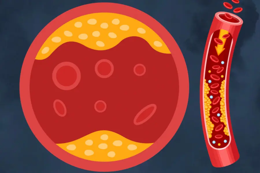 10 Symptoms That May Be Linked to Reduced Bl00d Flow From Blocked Arteries