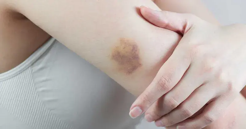 Notice These Bruises on Your Body? Pay Attention to What They May Be Signaling