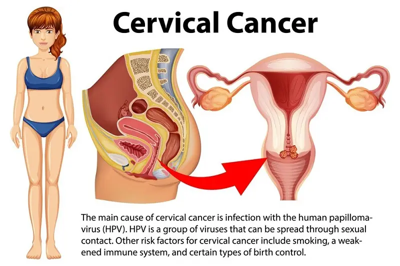 Your Body May Be Sending Warning Signs — 5 Possible Symptoms of Cervical Can.cer