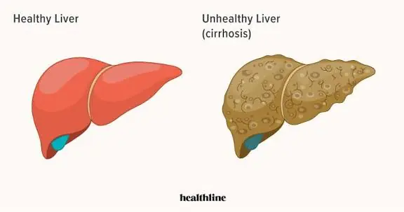 Doctors Warn: Certain Foot Symptoms May Sometimes Be Associated With Liver Problems