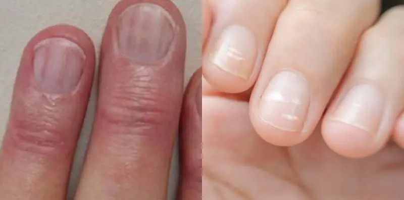 If You Notice Vertical Lines on Your Nails, Should You Be Worried? Here’s What Experts Say