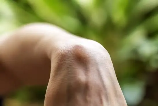 A Lump Has Appeared? Don’t Ignore It — Here’s What Could Be Behind It