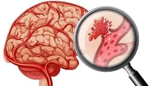 Living With Clogged Arteries? These 10 Signs May Be Easier to Miss Than You Think