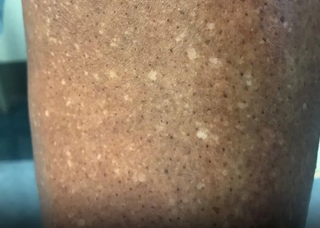 White Spots on Your Arms or Legs? Here’s What Your Body May Be Trying to Tell You