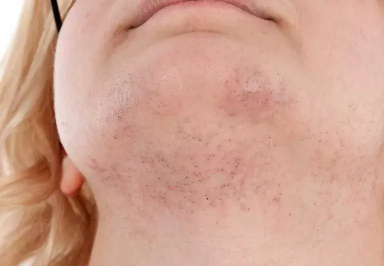 Chin Hair Appearing Out of Nowhere? Here Are the Possible Reasons