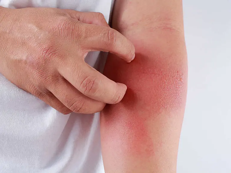 Your Skin Is Itchy and Covered in Small Bumps? Here’s What You Should Know