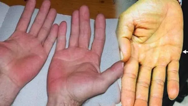 Don't Ignore These 5 Skin Changes That May Be Linked to Liver Health