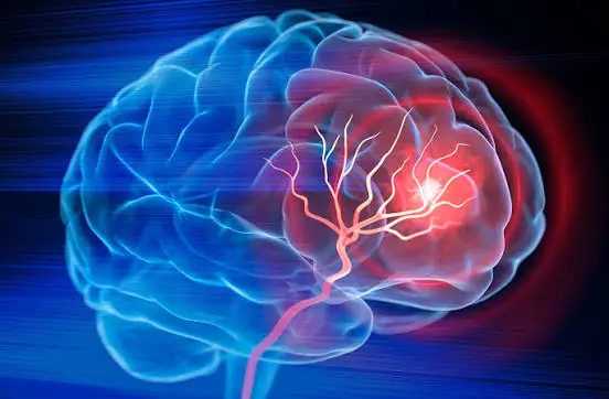 Don’t Ignore These Possible Brain Aneurysm Symptoms — Know the Warning Signs