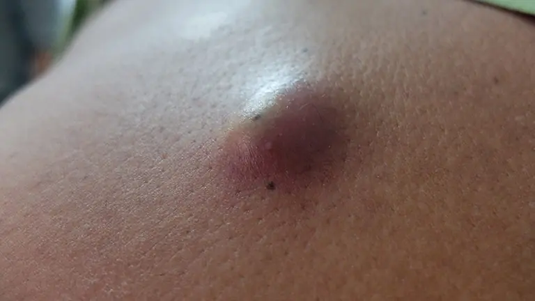 Sebaceous Cysts Explained: What Causes Them and What You Can Do