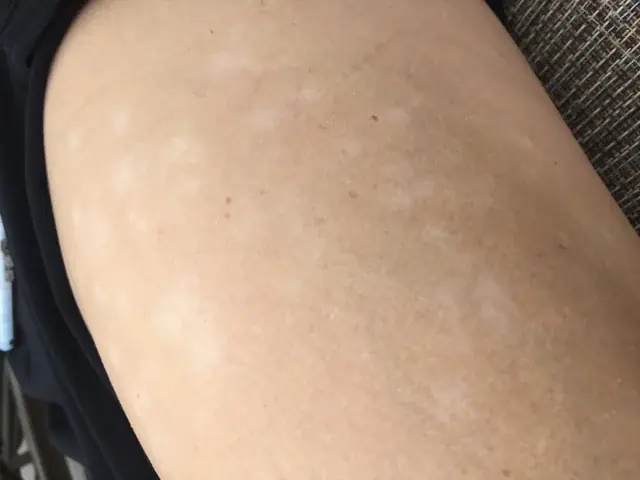 Those Tiny White Spots on Your Arms or Legs May Have a Reason—Here’s What a Skin Specialist Says.