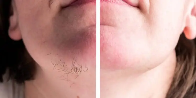 Chin Hair in Women: What’s Normal, What’s Not, and When to Take Notice