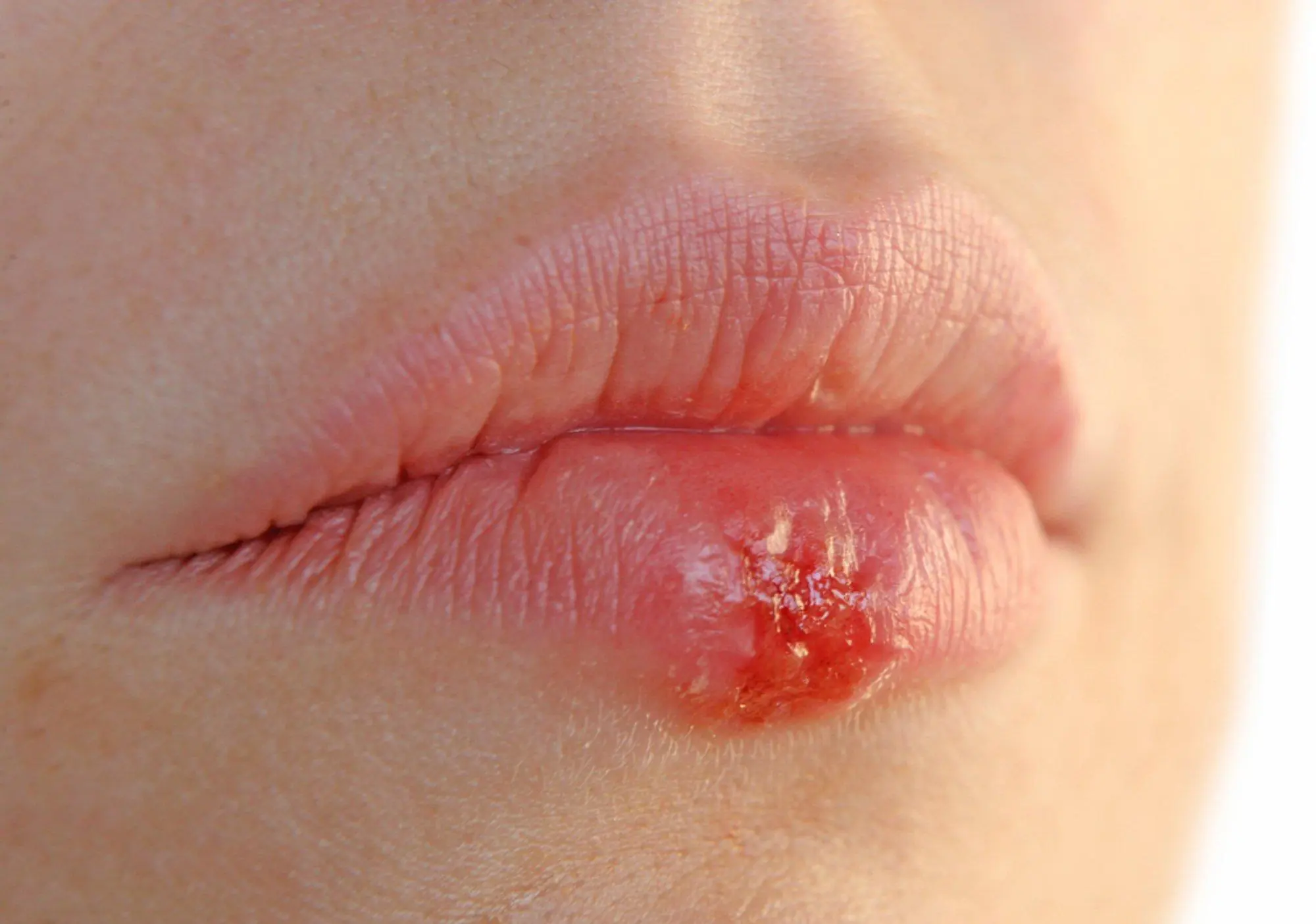The Hidden Link Between Cold Sores and Shingles: What Your Skin May Be Telling You