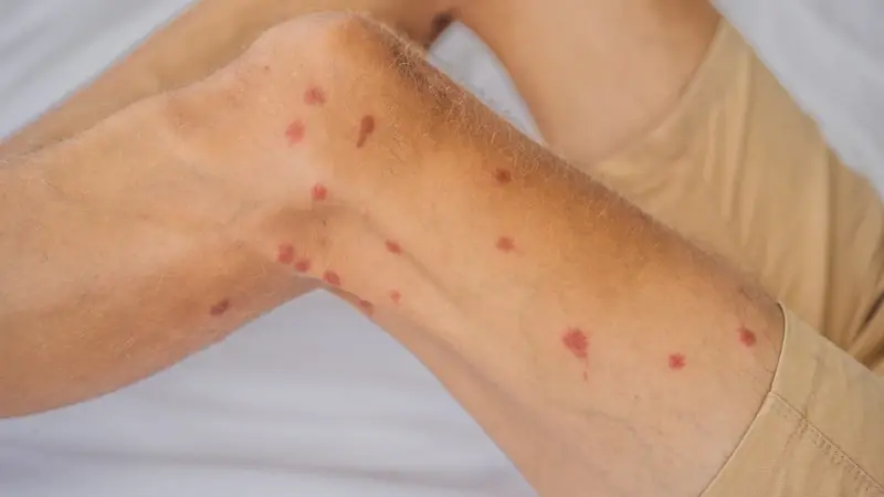 Those Red Dots on Your Skin May Have Different Causes - Here’s What to Know