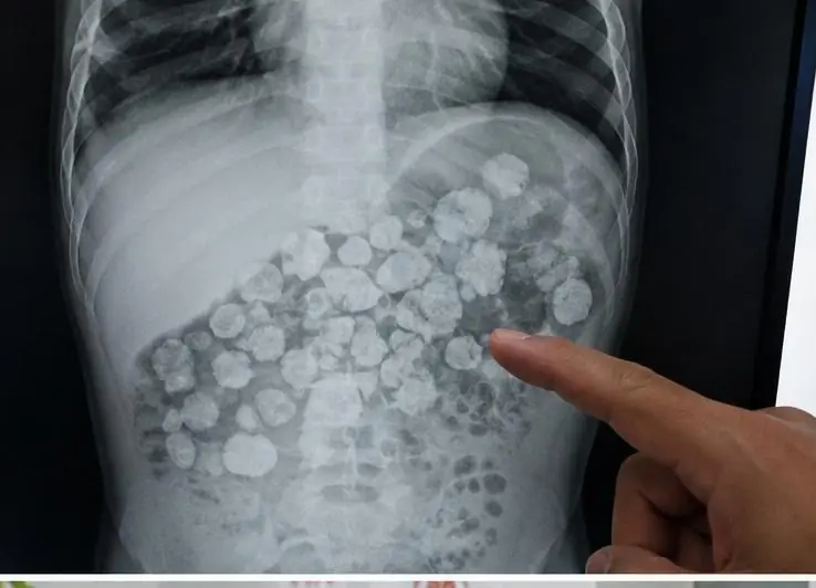 Doctors Were Shocked to Find a 5-Month-Old Baby’s Stomach Filled With Stones. The Hidden Cause Left Everyone Speechless