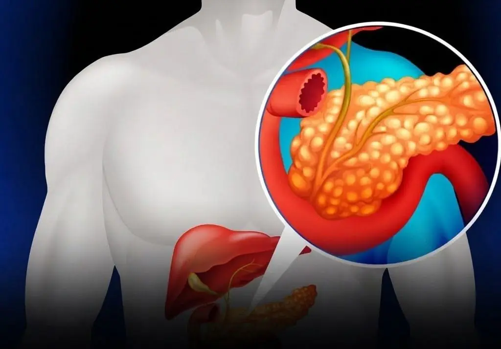 11 Symptoms That May Be Associated With Pancreatic Can.cer...