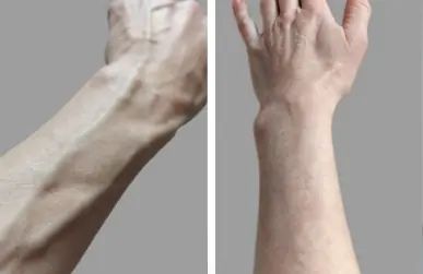Visible Veins Aren’t Always a Problem — But Here’s When You Should Pay Attention