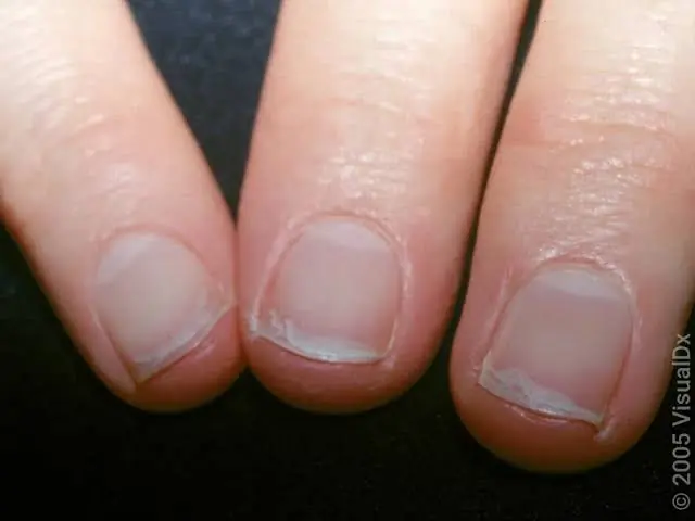 Nails That Split or Break Easily? Here Are Some Possible Reasons You Should Know