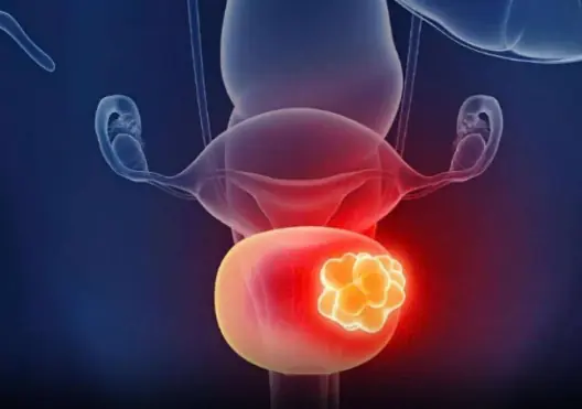 Bladder Cancer Often Starts Quietly: 5 Early Symptoms to Watch For