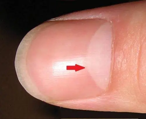 Nail Lunulae: What They Really Reveal About Your Health and Lifestyle
