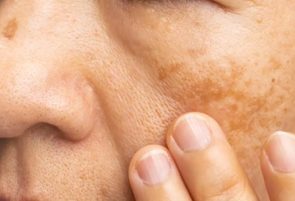 Dark Spots on Your Face? This Natural Remedy Is Already in Your Fridge