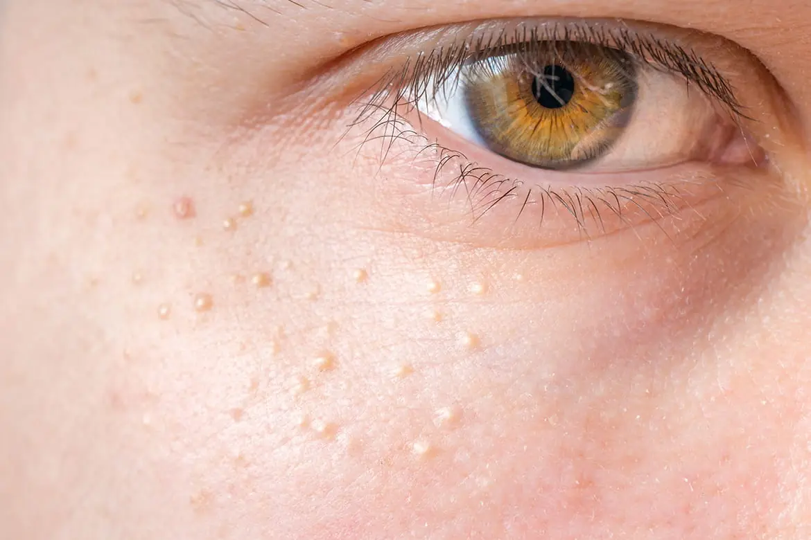 White Bumps on Your Face or Around Your Nose? Here’s What They May Be