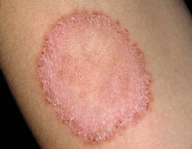 Fungal Skin Infection? Here Are the Warning Signs to Watch For