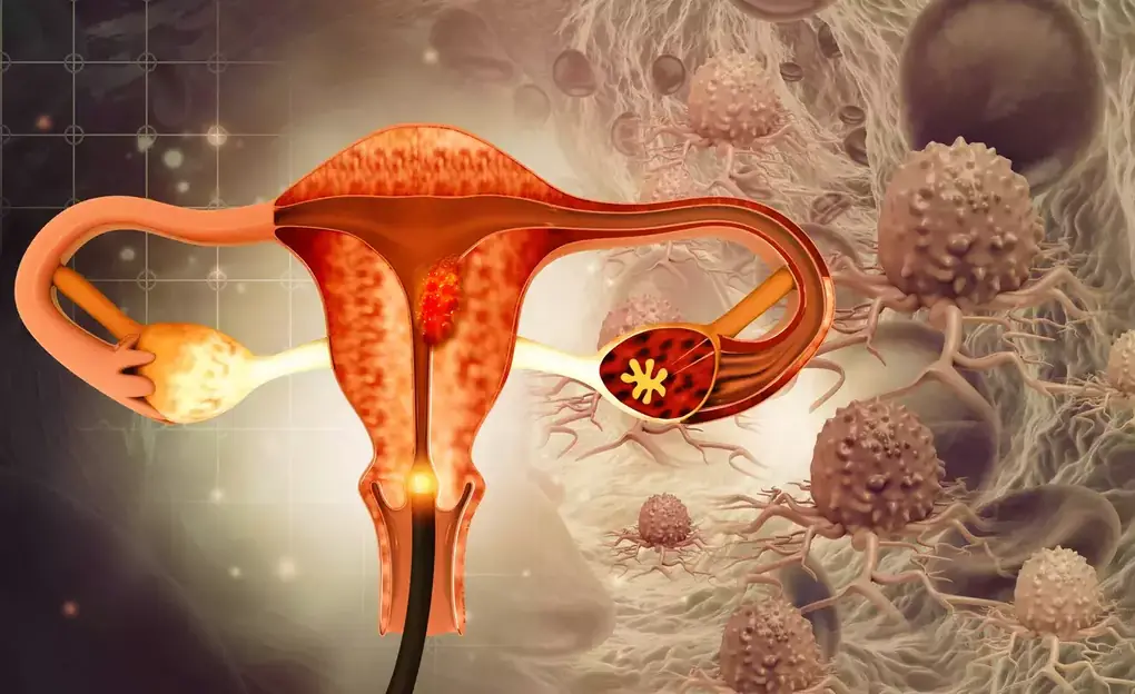 12 Possible Signs of Ovarian Can.cer You Need to Recognize