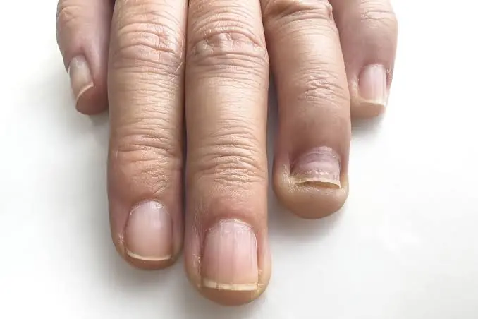 What Do Those Lines on Your Nails Really Mean? The Answer May Surprise You…