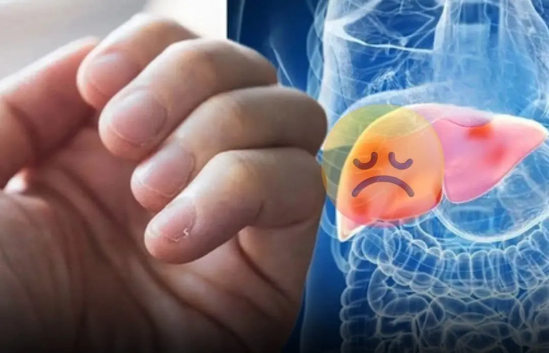 3 Hand Signs That May Signal Liver Failure — Even 1 Is a Reason to See a Doctor Immediately!