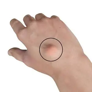 Notice a New Lump or Cyst? These Signs May Tell You When to Get It Checked…