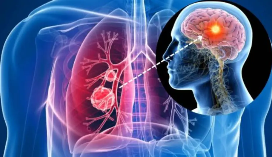 The Surprising Reasons Lung Can.cer Can Affect People Who Never Smoked