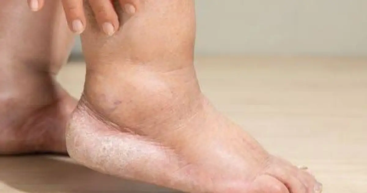 Why Are Your Legs Swollen? The Reason May Be More Than Just Tiredness…
