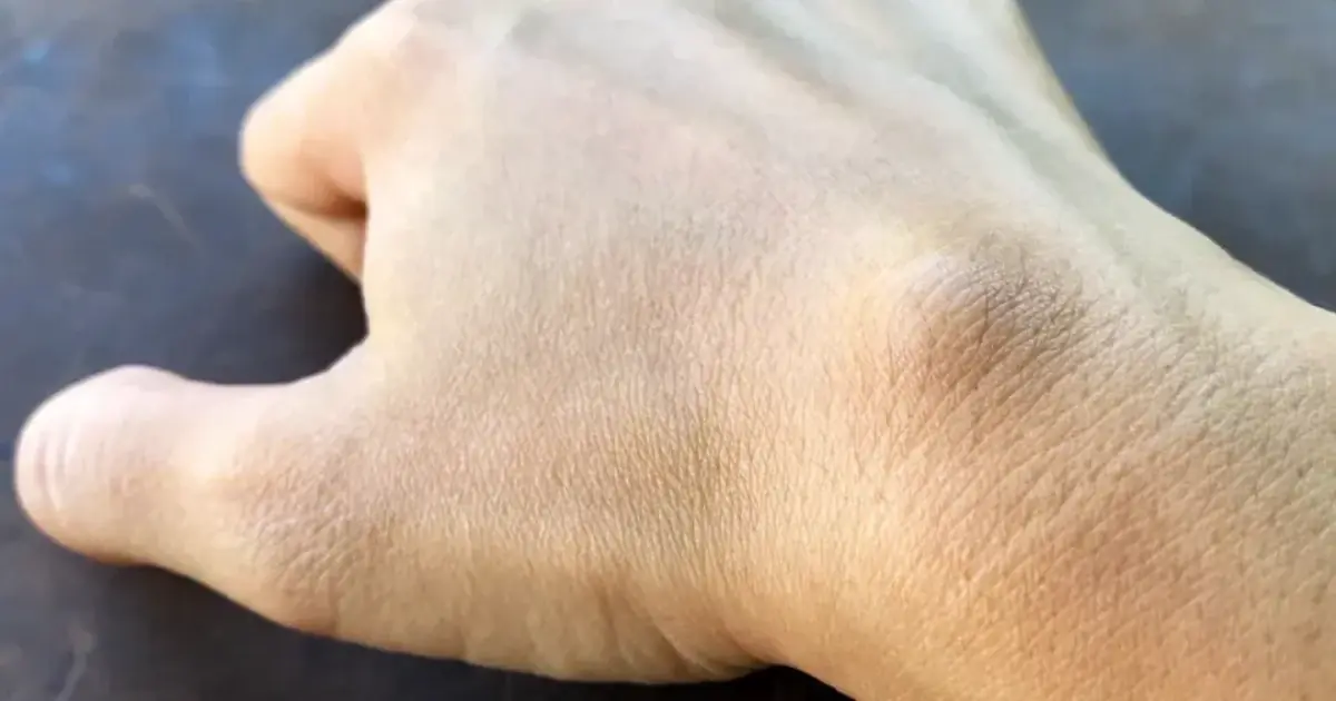 That Small Lump Might Be Nothing—But Here’s When It Could Signal a Bigger Problem