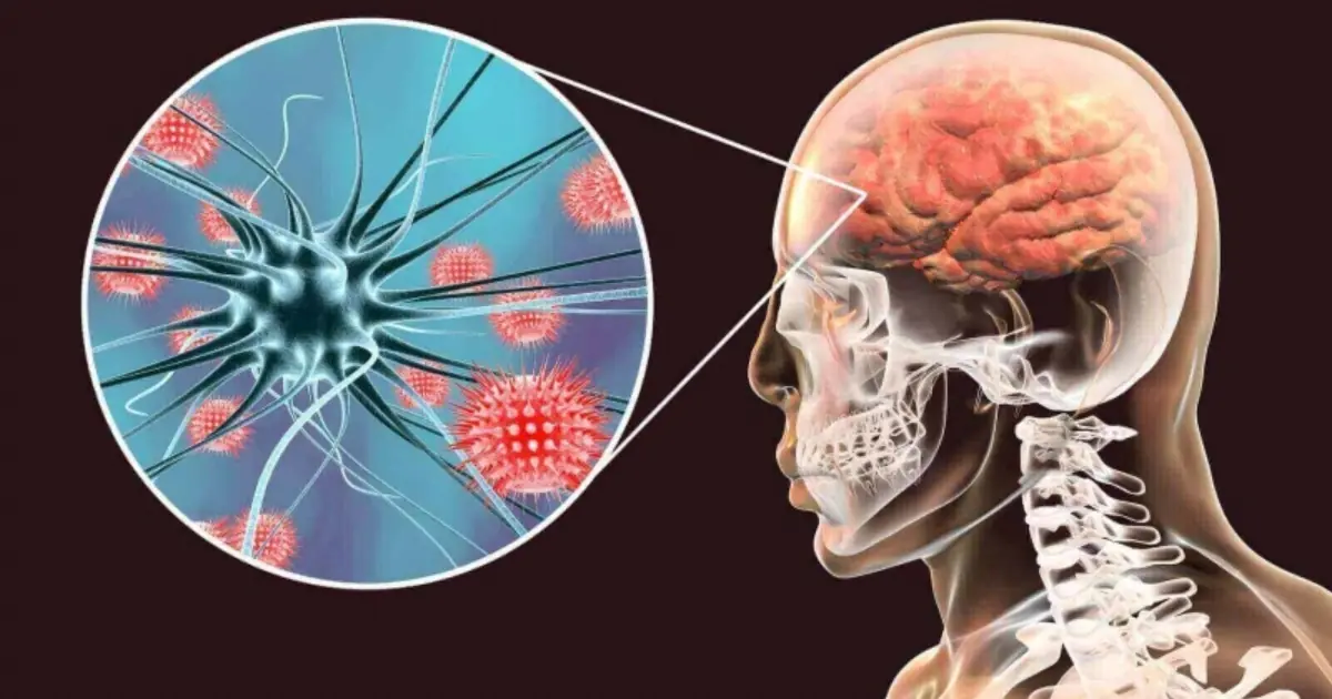 Recognizing Meningitis Early: Important Symptoms You Should Know